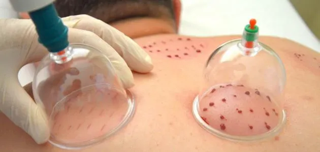 مركز الحكمة للعلاج بالحجامة photo 1