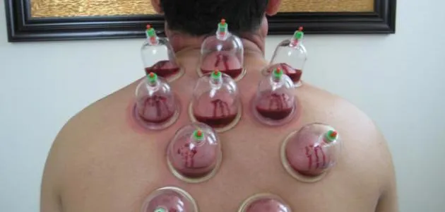 مركز الحكمة للعلاج بالحجامة photo 2